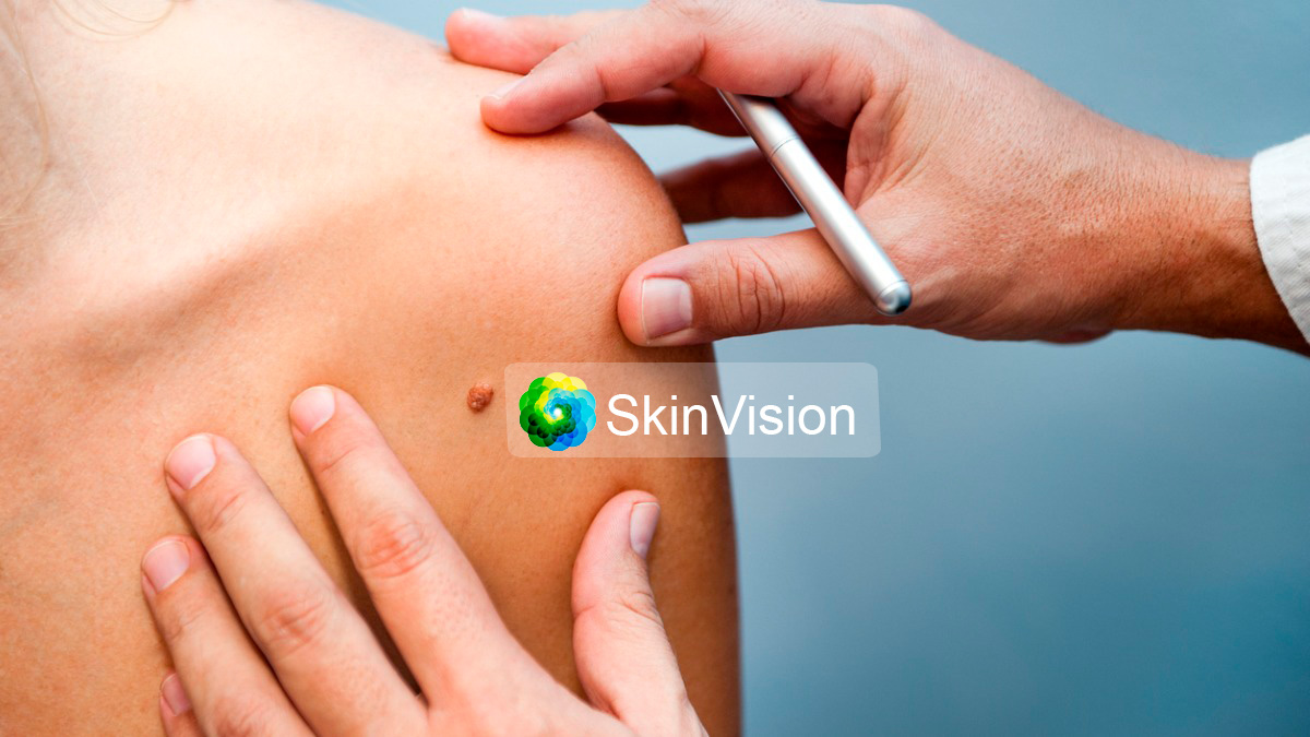 App SkinVision voor vroegtijdige opsporing van huidkanker